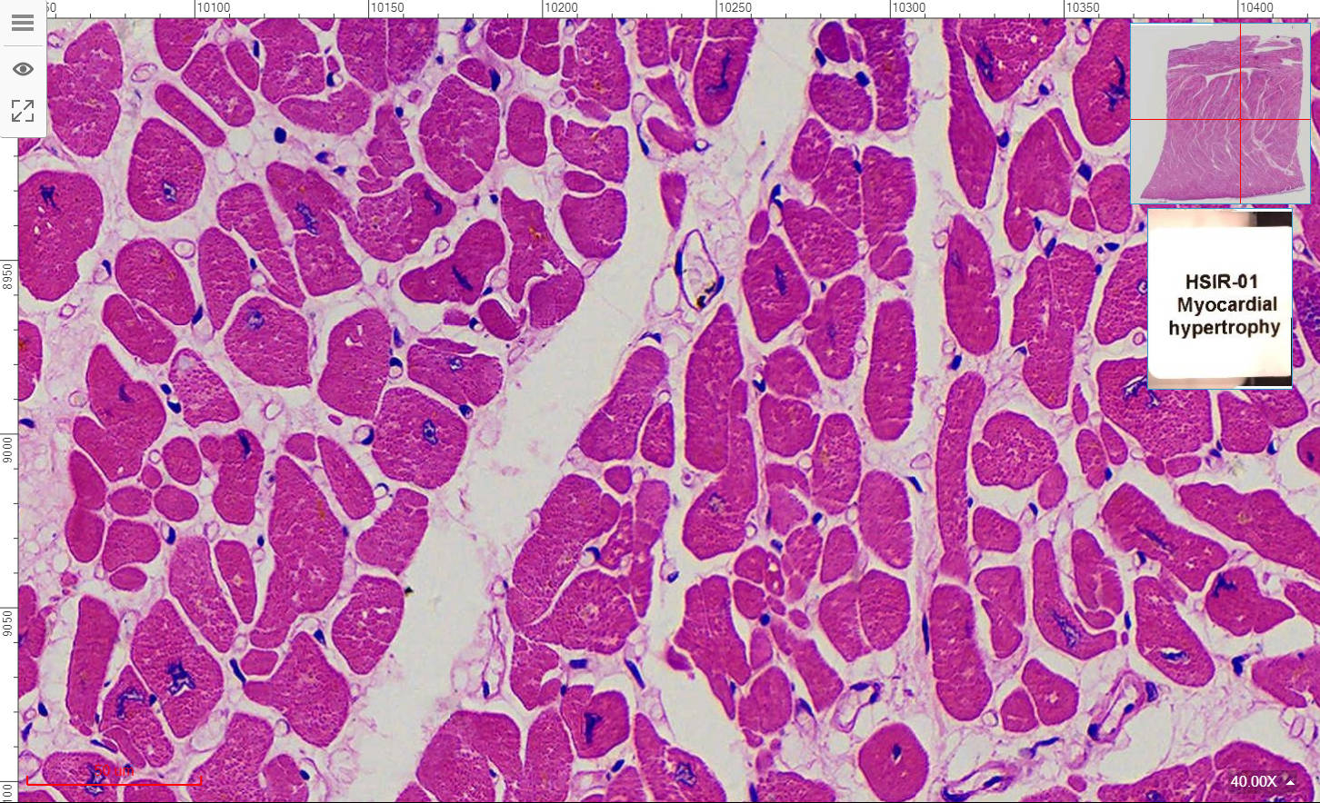 Myocardial hypertrophy section, 7um, H.E. Stain, University Standard ...