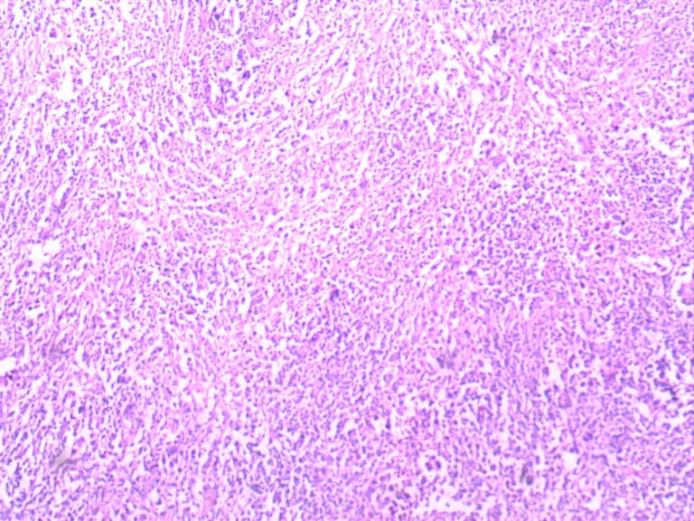 most common presentation of hodgkin lymphoma