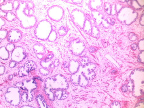 Poorly differentiated prostate cancer