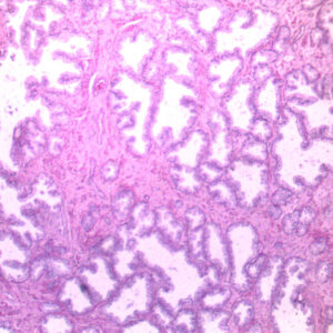 well differentiated prostate cancer