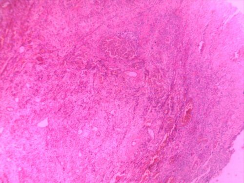 Skin Inflammation - smooth muscle cellulitis 4x