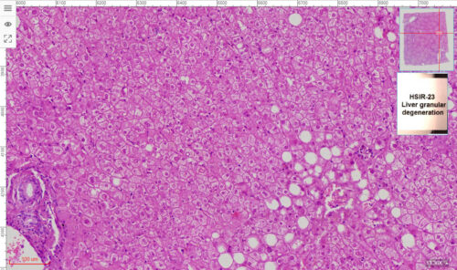 HSIR-23 Liver granular degeneration