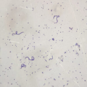 Malay microfilaria smear