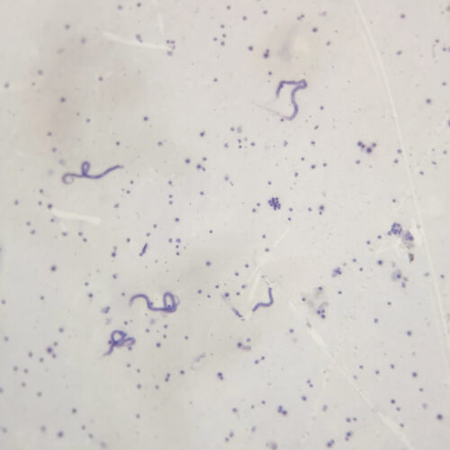 Malay microfilaria smear